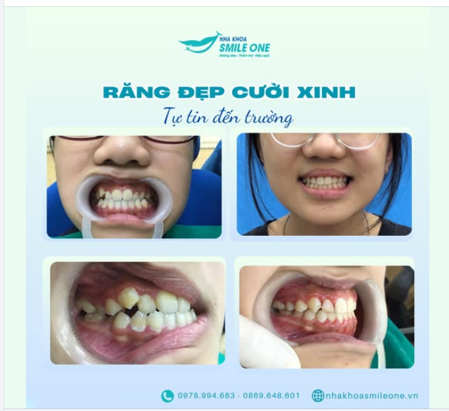 BẠN CÓ NGẠI CƯỜI VÌ RĂNG QUÁ XẤU KHÔNG?