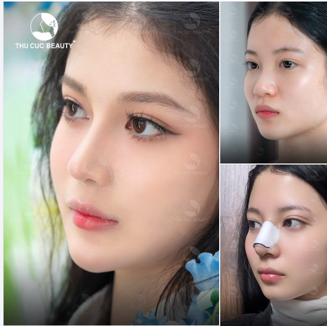 Quyết định nâng mũi là điều đúng đắn, dáng mũi sau nâng 10 điểm không có nhưng!!