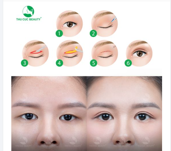 Cắt mí TC định hình nếp mí phù hợp với gương mặt của bạn