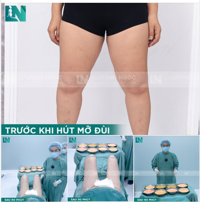 NỖI ÁM ẢNH MANG TÊN " ĐÙI ẾCH "