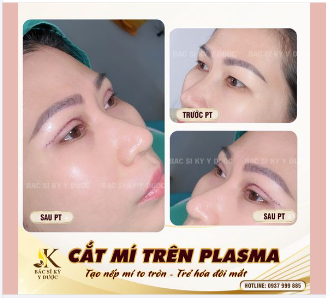 Mí Đẹp Tự Nhiên - Kết Quả Ngay Sau Phẫu Thuật!