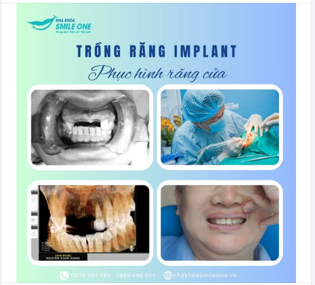 ĐIỀU ƯỚC CỦA BA MẸ LÚC TUỔI GIÀ: ĂN UỐNG KHÔNG CÒN LÀ NỖI ÁM ẢNH DO MẤT RĂNG