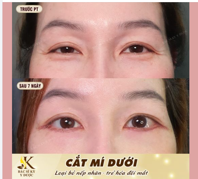 Sở hữu đôi mắt đẹp tự nhiên nhờ CẮT MÍ DƯỚI