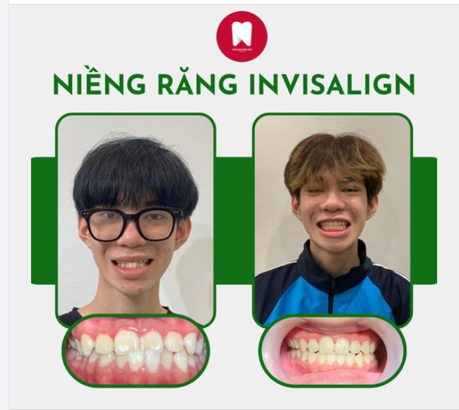 HOÀN THIỆN NỤ CƯỜI - CHẠM TAY TỚI TỰ TIN