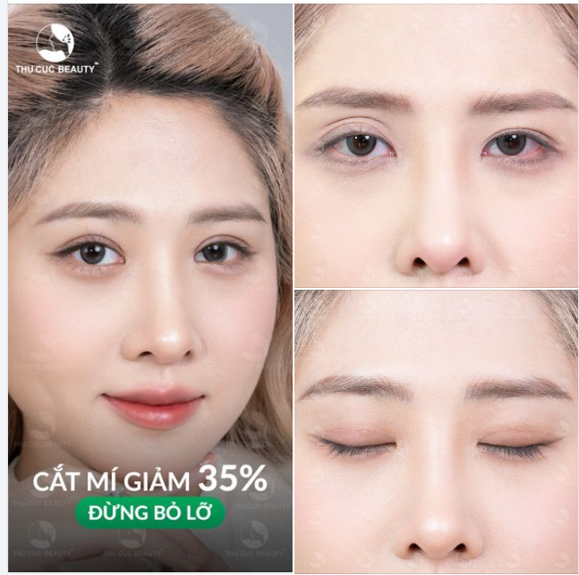 Xóa tan nếp mí không rõ nét thiếu cân đối