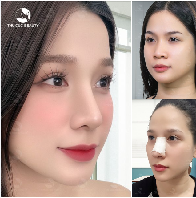 Chia tay mũi thấp tẹt. Hô biến dáng mũi cao tây, thời thượng