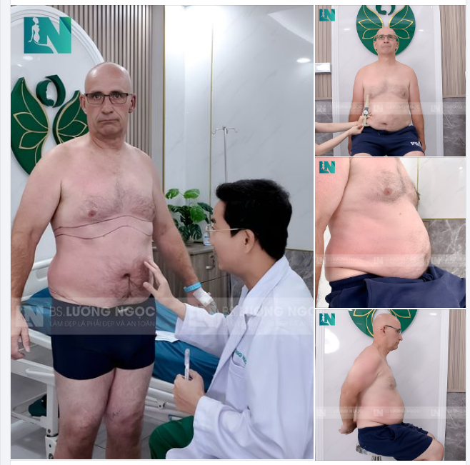 CHUẨN BỊ LÊN CA "HÚT MỠ BỤNG KHỦNG" CHO ANH KHÁCH TÂY