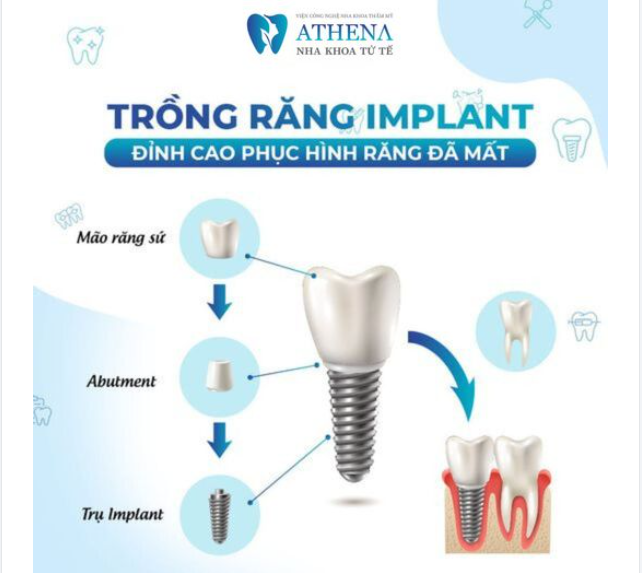 Trồng răng Implant hiện nay đang là phương pháp khôi phục răng đã mất được nhiều khách hàng tin tưởng lựa chọn nhất bởi những LỢI ÍCH sau: