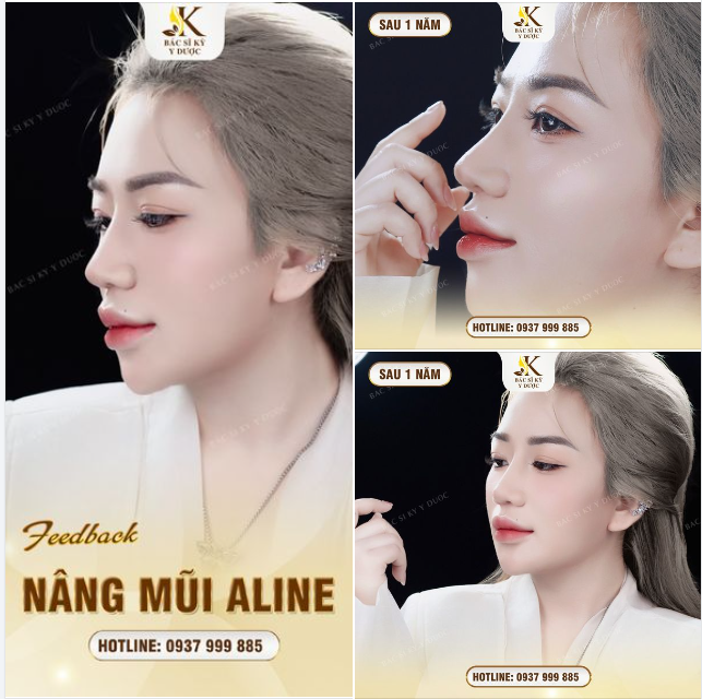 CHỈ CÒN HÔM NAY - CƠ HỘI CUỐI CÙNG NÂNG MŨI ALINE VỚI 15TR9