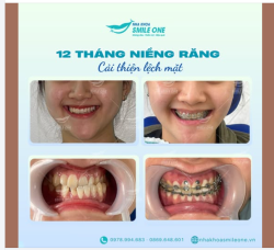 12 THÁNG NIỀNG RĂNG CẢI THIỆN LỆCH MẶT