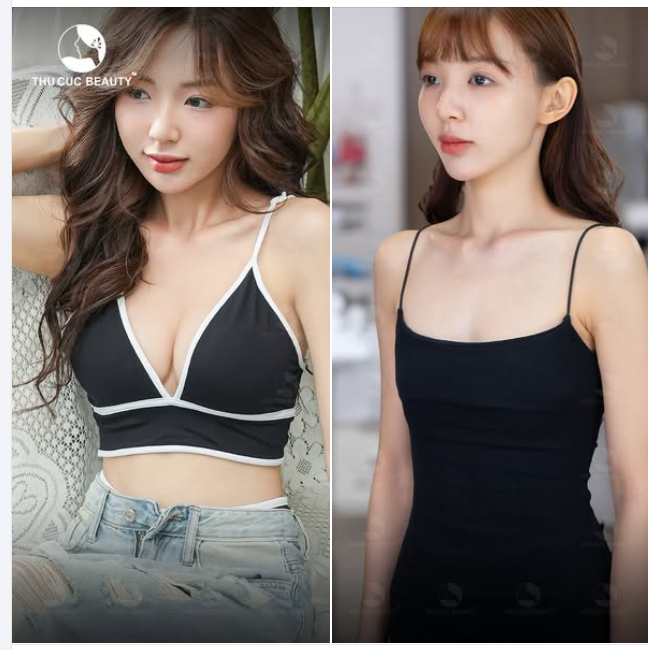 Giải pháp dành cho chị em có V1 khiêm tốn