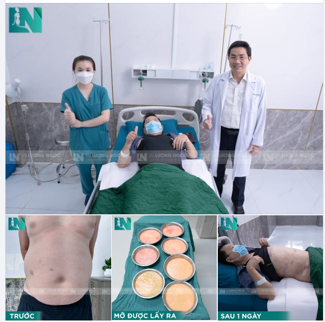 LẤY SẠCH MỠ THỪA CHO ANH KHÁCH U70