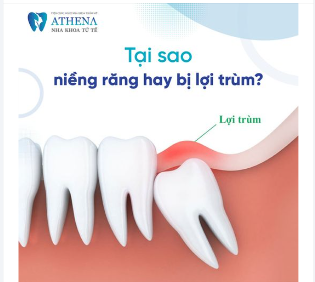 Niềng răng hay bị lợi trùm tại sao nhỉ?
