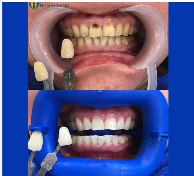 RĂNG TRẮNG SÁNG CƯỜI TỰ TIN