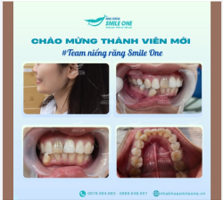 CHÀO MỪNG THÀNH VIÊN MỚI TEAM NIỀNG RĂNG SMILE ONE