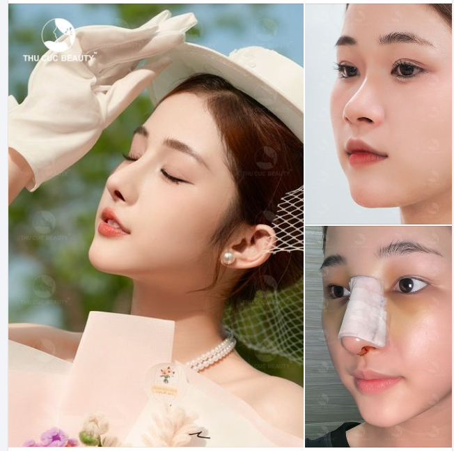 Mũi thấp khiến gương mặt kém sang bạn hãy gọi ngay cho TC