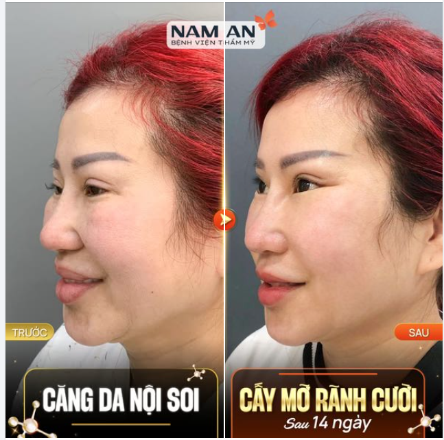 CĂNG DA ĐỂ THÀNH NGƯỜI KHÁC