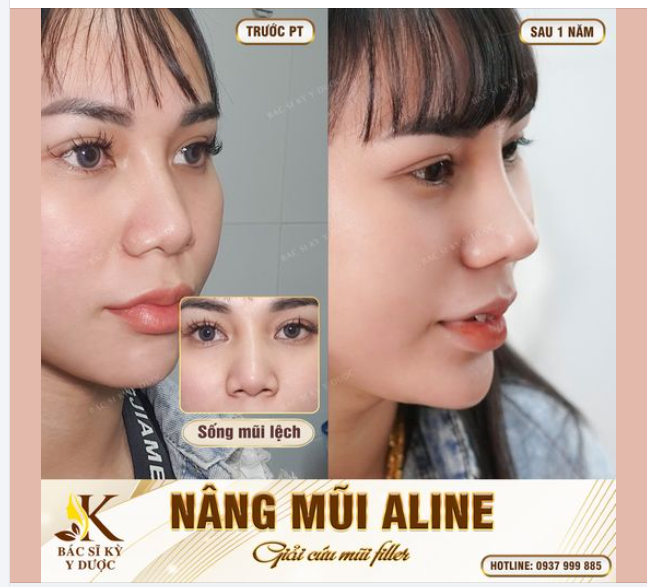 KẾT QUẢ SAU 1 NĂM GIẢI CỨU MŨI FILLER - SỞ HỮU DÁNG MŨI ALINE ĐẸP TỰ NHIÊN