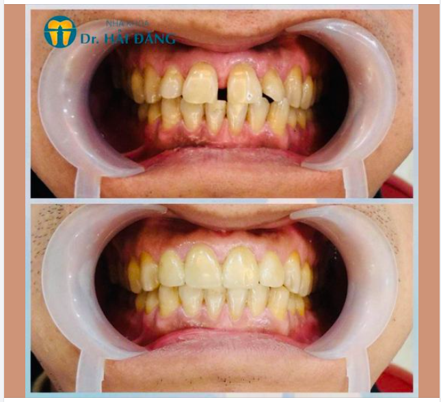 BỌC RĂNG SỨ ĐIỀU TRỊ RĂNG THƯA