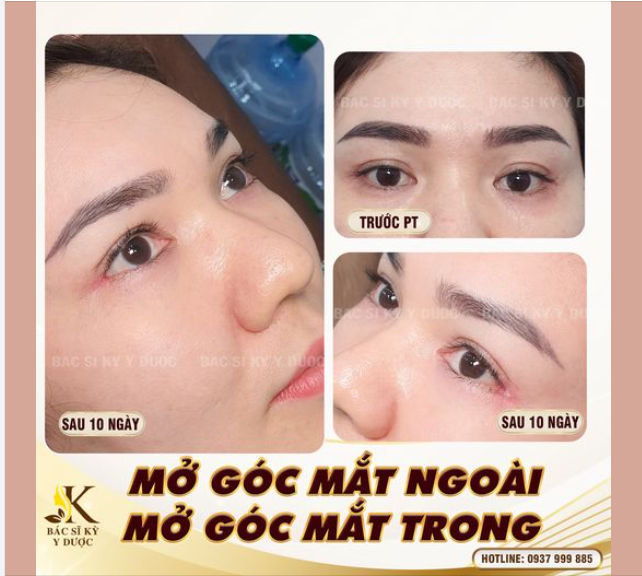 MỞ GÓC MẮT - BÍ QUYẾT CHO ĐÔI MẮT TO TRÒN CUỐN HÚT