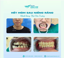 HÀM RĂNG MÓM NẶNG KHÔNG NHA KHOA NÀO NHẬN VÀ LỜI KHUYÊN TỪ CHUYÊN GIA VIỆT PHÁP.