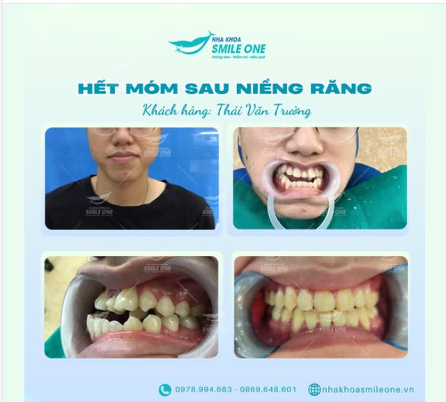 HÀM RĂNG MÓM NẶNG KHÔNG NHA KHOA NÀO NHẬN VÀ LỜI KHUYÊN TỪ CHUYÊN GIA VIỆT PHÁP.