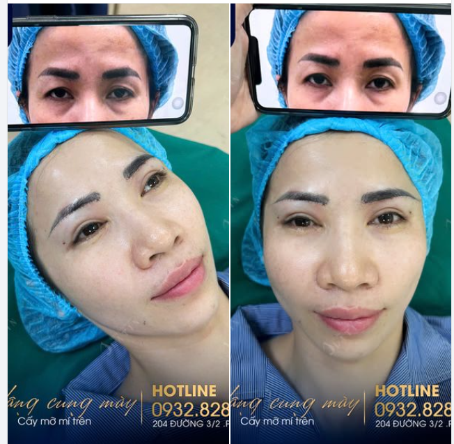 Treo cung mày kết hợp cấy mỡ mí trên - Trẻ hóa đôi mắt cho chị gái K.H