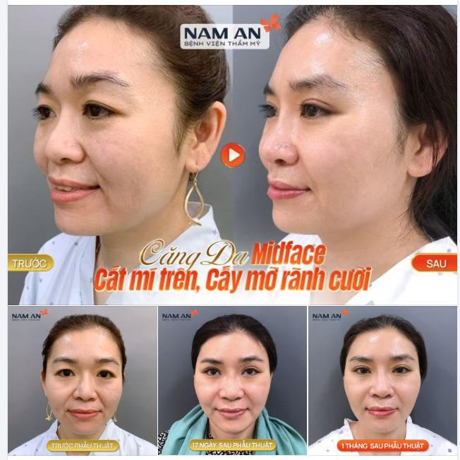 Trẻ Hơn 10 Tuổi Nhờ Căng Da Tại Nam An