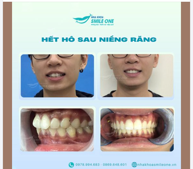 RĂNG XẤU KHÔNG DÁM CƯỜI, CHỈ CÓ BẠN MỚI HIỂU