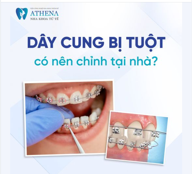 Dây cung niềng răng bị tuột có nên điều chỉnh tại nhà