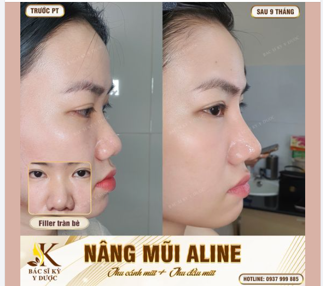Dáng mũi ALINE sau 9 tháng thực hiện, vô cùng xinh xắn.