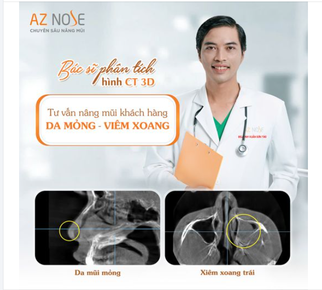 Tư vấn nâng mũi cho khách hàng 2K bị viêm xoang