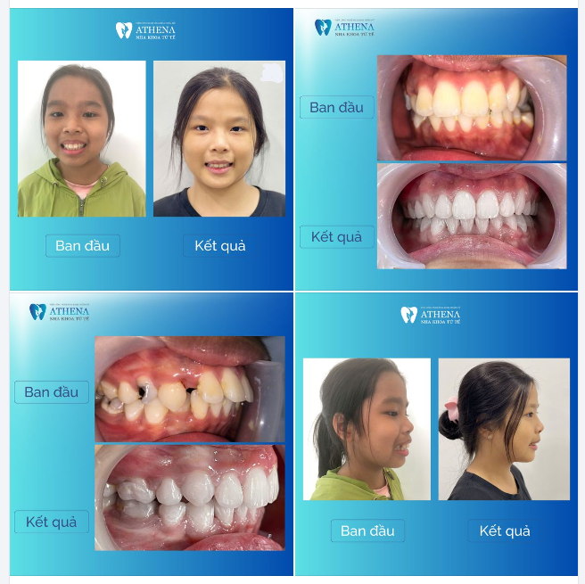 Khách hàng nhí Trần Hoàng Ngọc Linh, sinh ngày 26/04/2011, đã có một hành trình thay đổi ấn tượng.