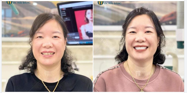 BỌC RĂNG SỨ GIẢI PHÁP HOÀN HẢO CHO NỤ CƯỜI ĐẸP