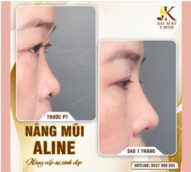 NÂNG CẤP SỰ XINH ĐẸP VỚI DÁNG MŨI ALINE