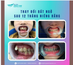 THAY ĐỔI SAU 12 THÁNG NIỀNG RĂNG