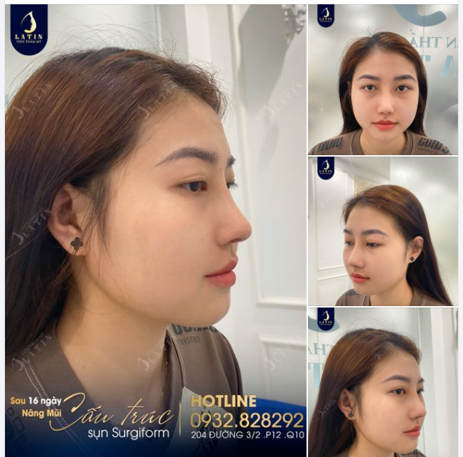 16 NGÀY THĂNG HẠNG NHAN SẮC, TỰ TIN VỚI CHIẾC MŨI XINH