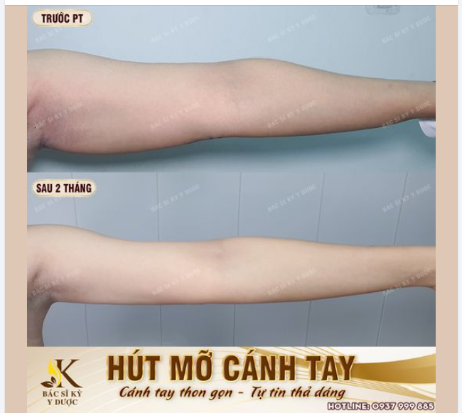 Kết Quả Hút Mỡ Cánh Tay Sau 2 Tháng