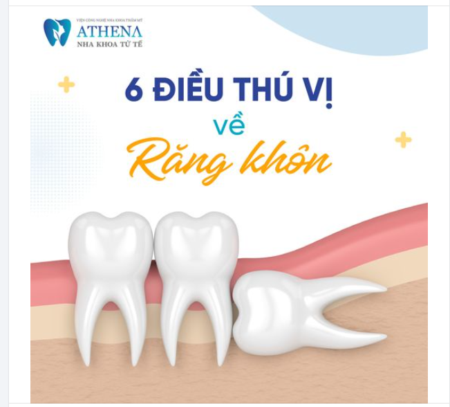 6 điều thú vị về răng khôn không phải ai cũng biết