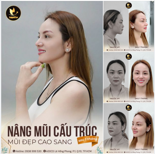 MŨI ĐẸP CAO SANG - NÂNG HẠNG THẦN THÁI  SAU 1 THÁNG NÂNG MŨI CẤU TRÚC CÙNG DR. HOẠT