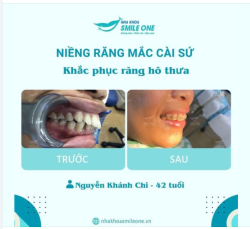 Niềng răng ở người lớn tuổi: Có nên không?