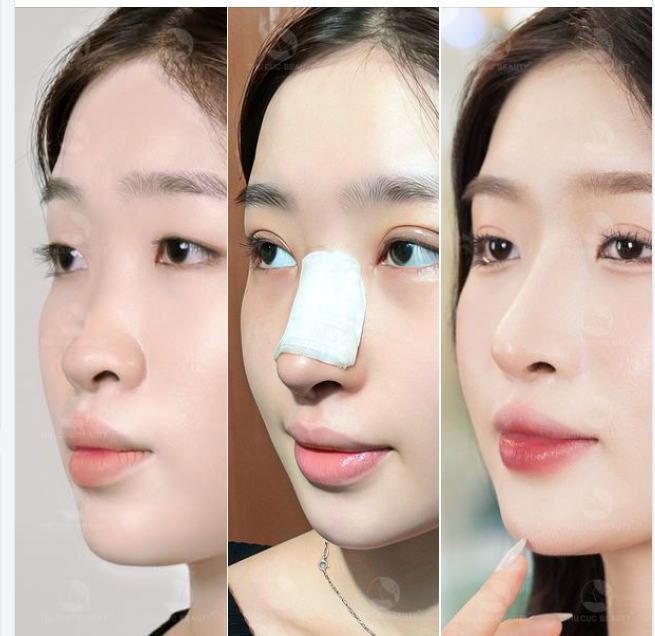 ​​​​​​​Thẩm mỹ TC Khắc phục hoàn toàn sống mũi thấp, đầu mũi to sau 30P