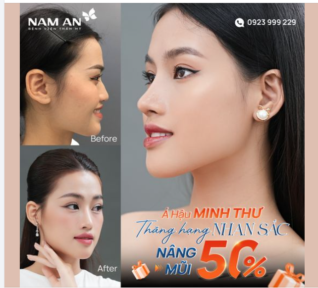 FLEX MŨI ĐẸP THANH TÚ SAU 2 NĂM NÂNG MŨI CỦA MINH THƯ