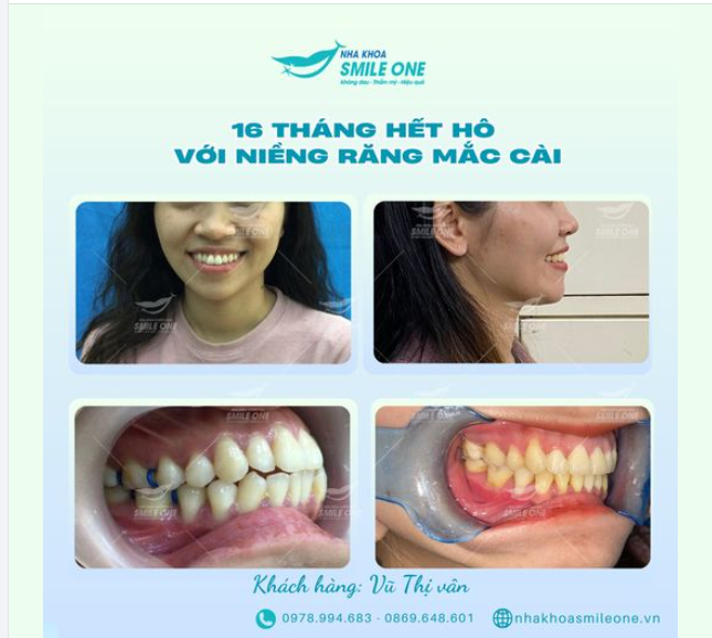 16 THÁNG HẾT HÔ – LẤY LẠI NỤ CƯỜI TỰ TIN CÙNG SMILE ONE