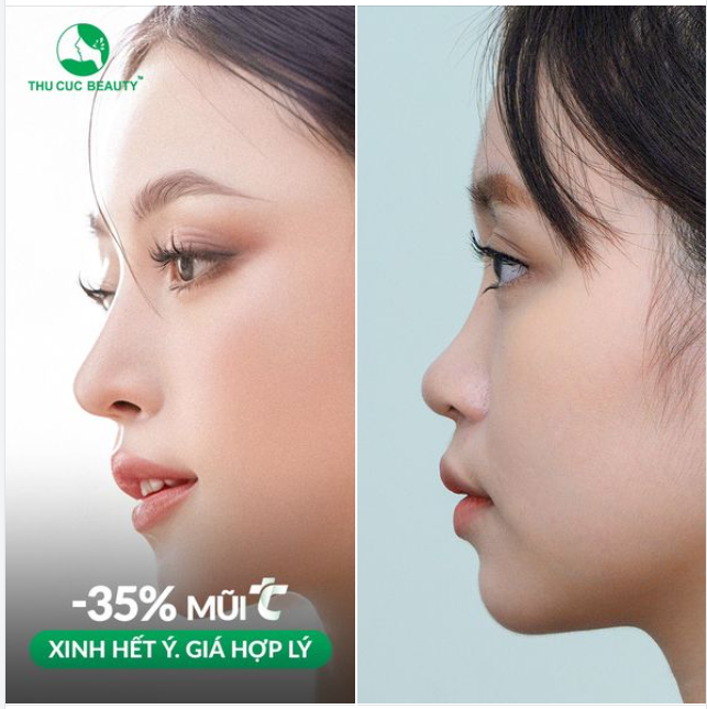 Mũi TC -35%  Bye mũi tẹt. Đẹp tự nhiên tự tin chấp mọi khung hình