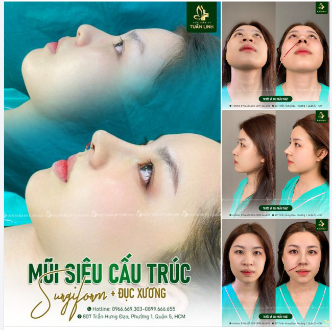 Nâng Mũi Siêu Cấu Trúc Surgiform + Đục Xương Sự Lựa Chọn Đỉnh Cao Cho Dáng Mũi Đẹp Hoàn Hảo!!