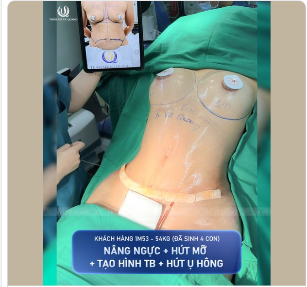 Ngay lúc này, Bác sĩ và ekip vừa hoàn thành một ca siêu combo cho khách cũ đã nâng mũi tại Thẩm mỹ Vũ Quang từ 6 năm trước!