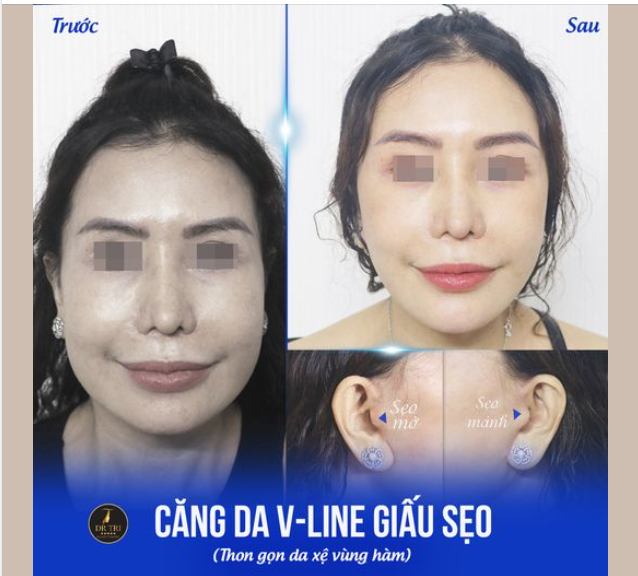 Kiên nhẫn 2 tháng để sở hữu vẻ đẹp VLine trẻ trung!
