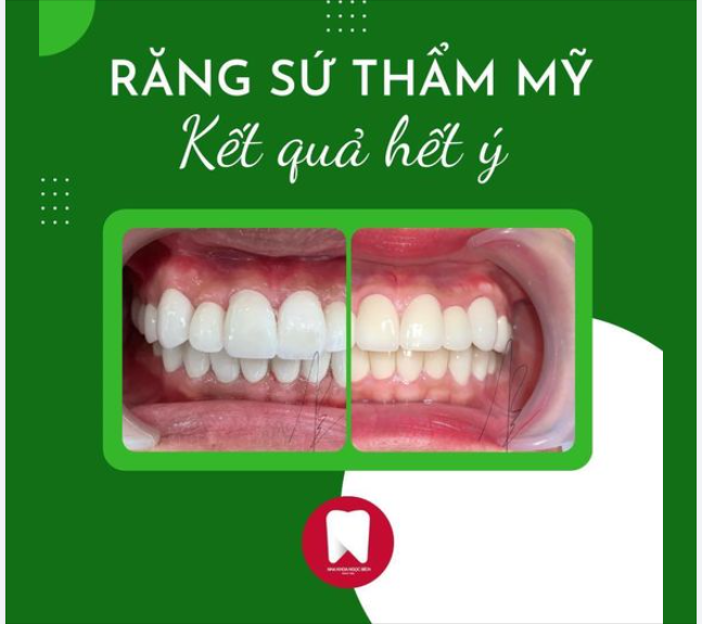 VÌ SAO NÊN LÀM RĂNG SỨ TẠI NHA KHOA NGỌC BÍCH