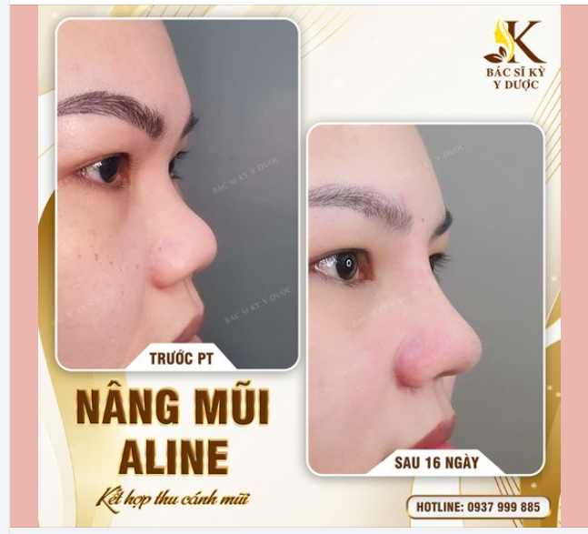 +1000 ĐIỂM TỰ TIN SAU KHI NÂNG MŨI